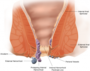 1359375114421_Hemorrhoids